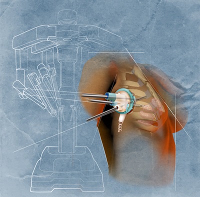 animated Robotic-Assisted da Vinci Xi Prophylactic Nipple-Sparing Mastectomy
